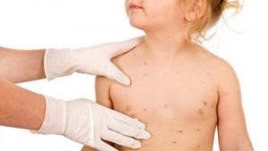 Dermatitis Herpetiformis, A Trace Of Celiac Disease On The Skin?
