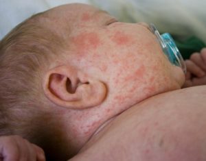 Miliaria In Babies