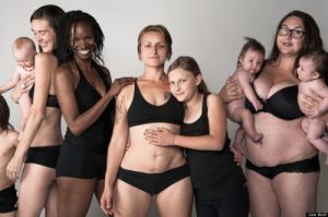 5 Tips To Recover From Abdominal Diastasis