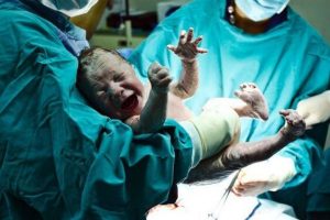 Could C-Sections Be Detrimental to Health?