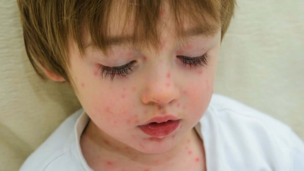 What You Need to Know about Scarlet Fever - You are Mom
