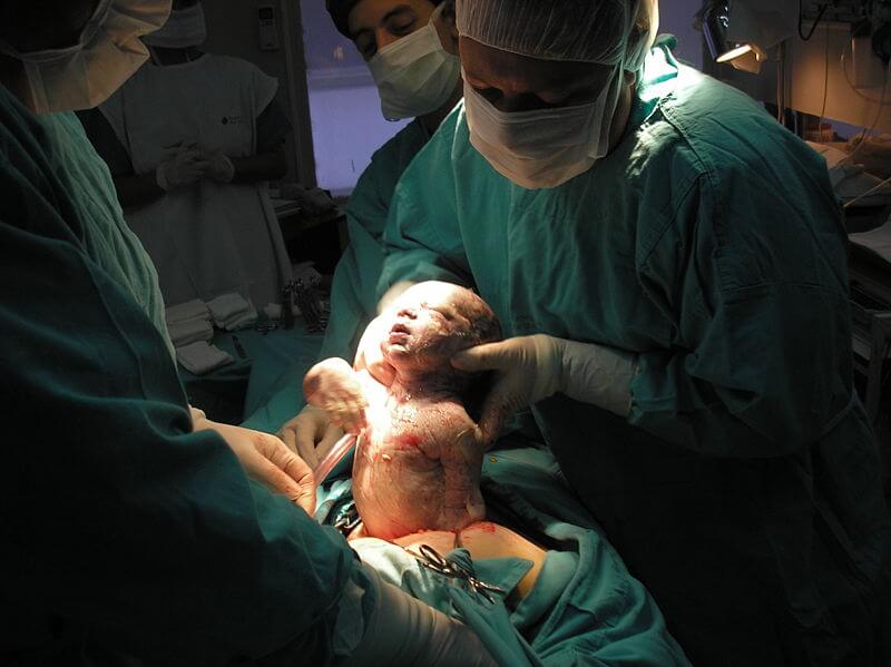 woman having a c-section