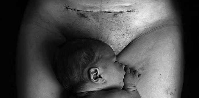 Cesarean Section is Not the "Easy Way"