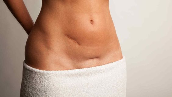 Cesarean Sections is Not the "Easy Way"