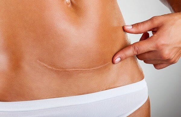 the evolutionary effects of c-sections on women's bodies