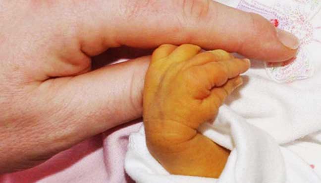 What Is Infant Jaundice And How Is It Treated?
