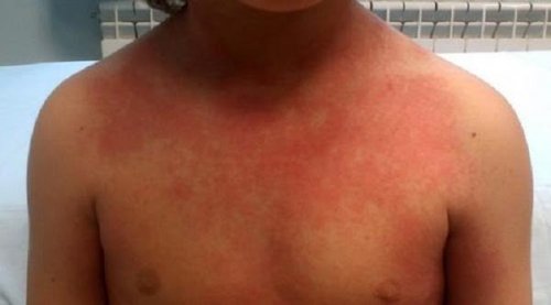 What Does Scarlet Fever Look Like On A Child