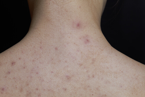 Scarlet Fever in Children