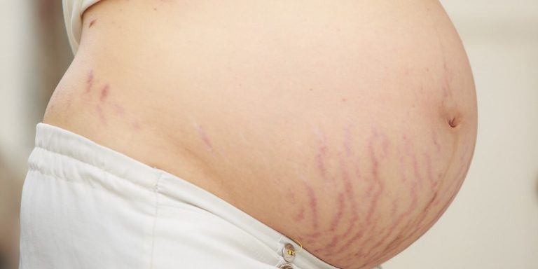 beskåret billede af gravid mave med strækmærker under navlen