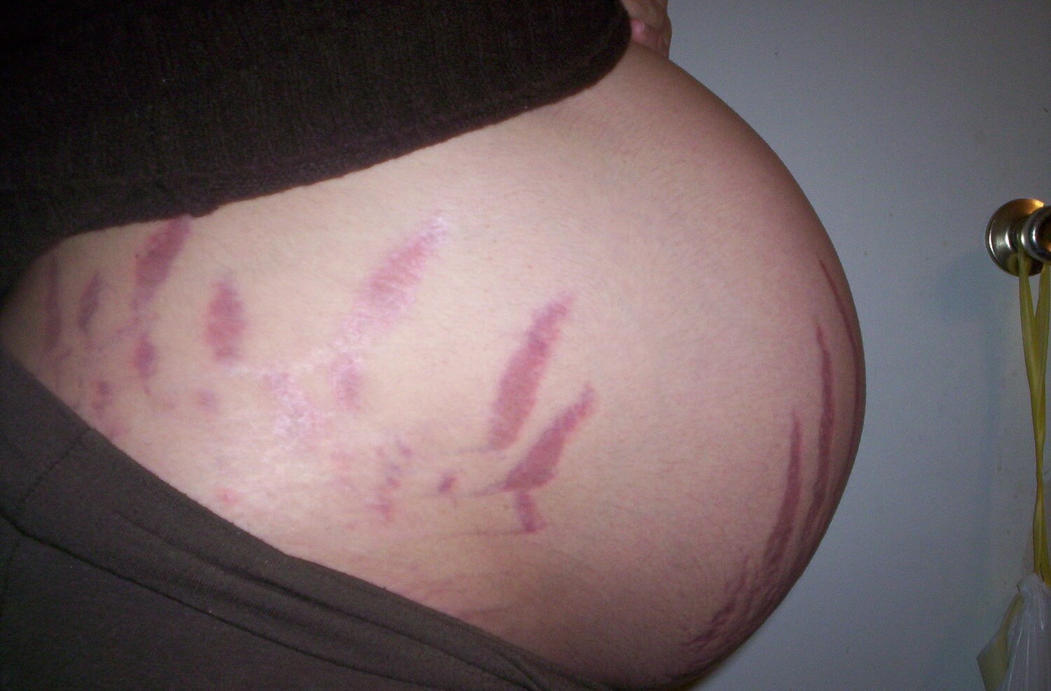Why Do We Get Stretch Marks During Pregnancy?
