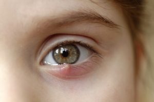 Styes in Children: How to Treat Them