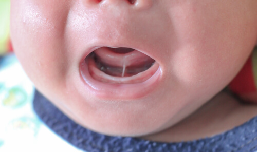 What is Ankyloglossia in Children?