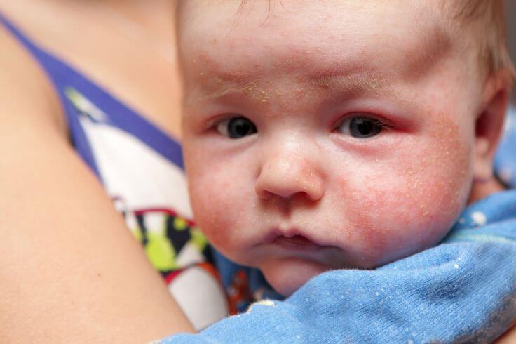 How to Fight Skin Rashes in Babies?