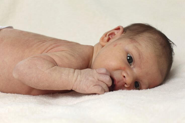 How To Fight Rashes in Babies?
