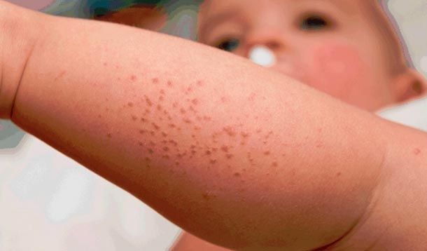 How To Fight Rashes in Babies?