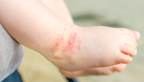 15 Tips for Dealing with Atopic Dermatitis in Children