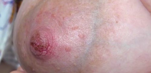 Preventing and Curing Sore, Cracked Nipples