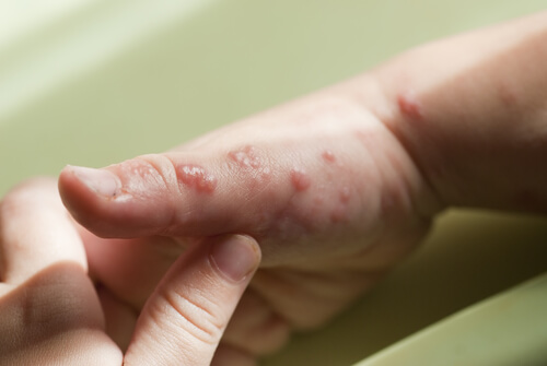 Herpes in Children: Symptoms, Causes and Treatment