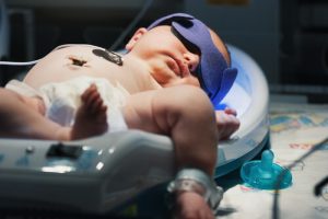Learn All About Newborn Jaundice