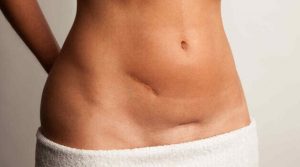 Today's Best Advice for Treating and Reducing the Appearance of Scars