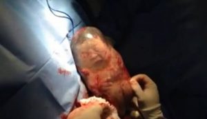 What Is a Veiled Birth?
