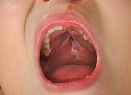 Children with a Cleft Palate: Everything You Need to Know