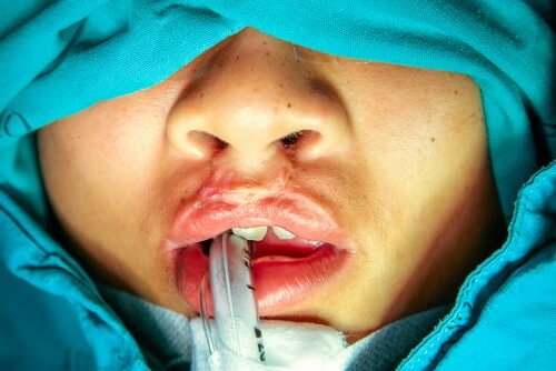Children with a Cleft Palate: Everything You Need to Know