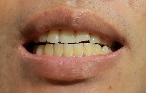 The Appearance of Stains on Permanent Teeth