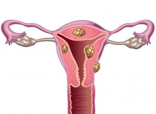 Fibroids and Infertility