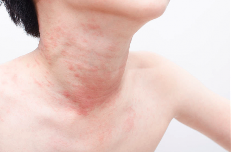 red-swelling-and-hives-on-the-neck-writing-pictures-urticaria-hives