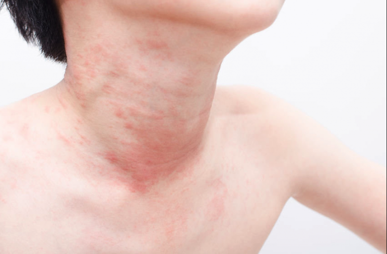 Chronic Hives in Children