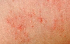 Chronic Hives in Children