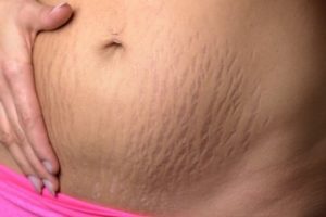 Stretch Marks: What Are They and How Can They Be Treated?
