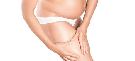 Stretch Marks: What Are They and How Can They Be Treated?