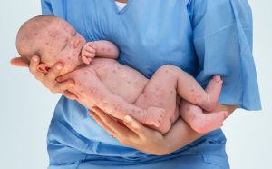 The Measles in Children: Symptoms, Treatment and Prevention