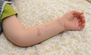 What to Do If Your Child Is Burned by Hot Water