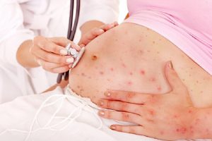 Congenital Varicella: What Is It And What Are Its Dangers?