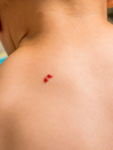 What Should I Do If My Child Has Angiomas?