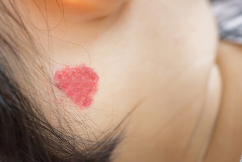 What Should I Do If My Child Has Angiomas?