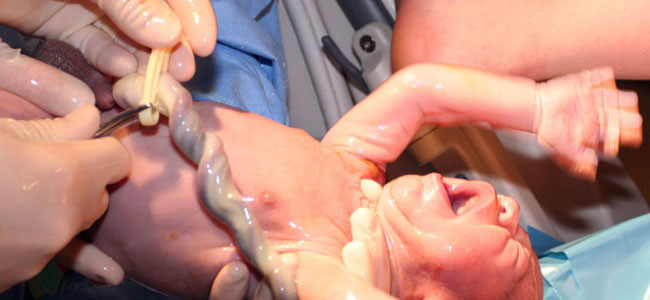 What are the Risks of Umbilical Cord Prolapse?