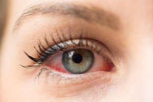 How to Prevent the Spread of Pink Eye among Children