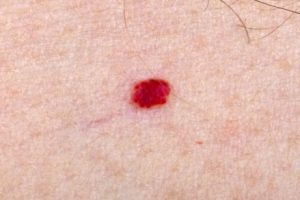What Should I Do If My Child Has Angiomas?