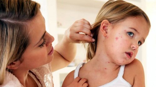 The Measles in Children: Symptoms, Treatment and Prevention