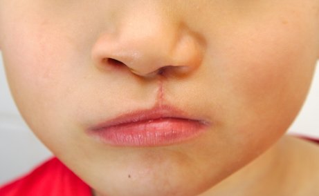 Cleft Lip: What Is It and What Are Its Consequences?