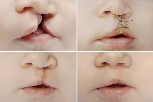 Cleft lip, what is it and what are its consequences