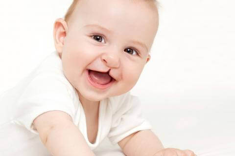 Cleft Lip, what is it and what are its consequences