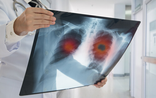 Cystic Fibrosis in Children