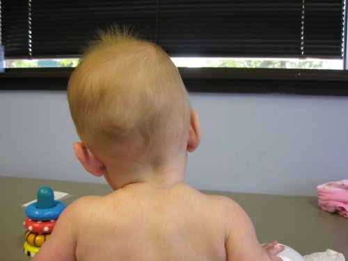 Scoliosis in Children: Everything You Need to Know