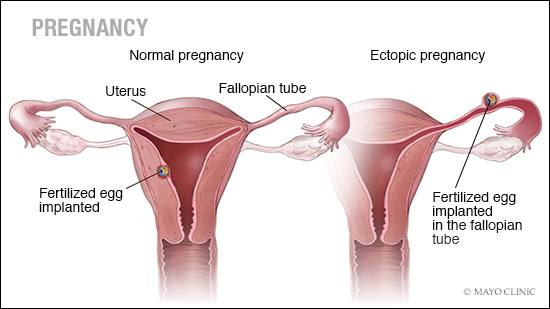 Ectopic pregnancy