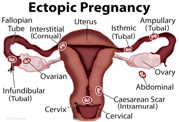Ectopic pregnancy
